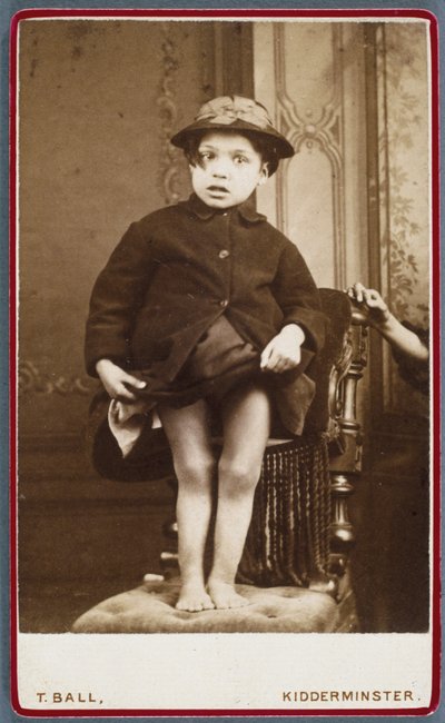 Enfermedades, Raquitismo Niño con raquitismo de Unbekannt