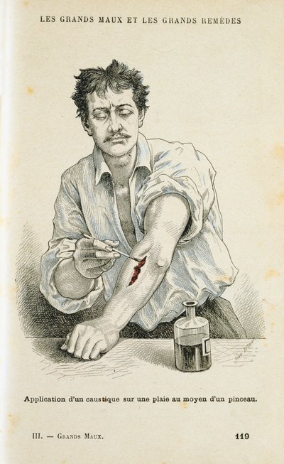 Pintando una herida con una solución antiséptica, c1890 de Unbekannt