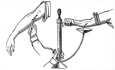 Transfusión de sangre de persona a persona, 1833 de Unbekannt