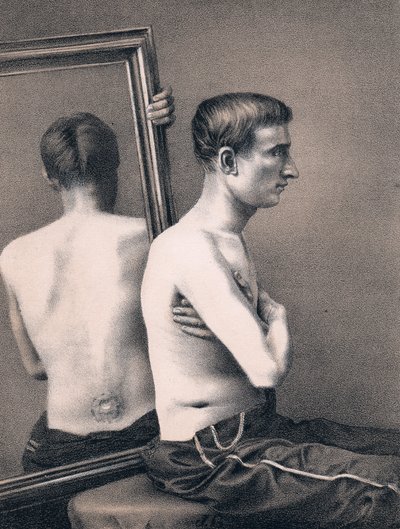 Recuperación de herido por bala en el abdomen, Guerra Civil Americana, 1865 de Unbekannt