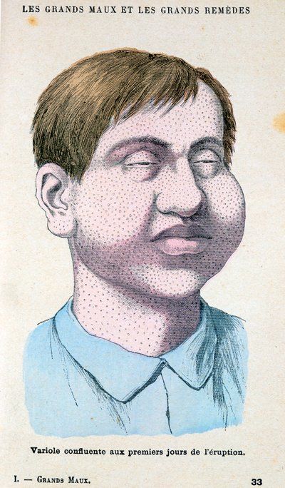Víctima de la viruela, c. 1890 de Unbekannt