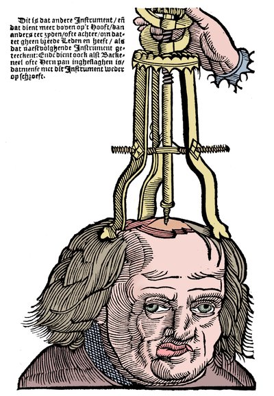 Trepanación, 1593 de Unbekannt