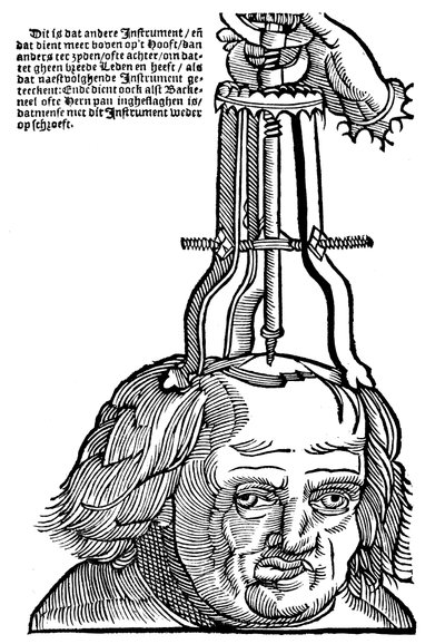Trepanación, 1593 de Unbekannt