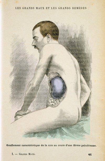 Bazo típico agrandado de un paciente con malaria, c1890 de Unbekannt