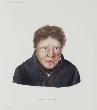 Enfermedades, Lepra Hombre leproso, Islandia, principios del siglo XIX de Unbekannt