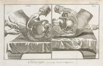 Equipamiento, Cirugía abdominal de la Edad Moderna de Unbekannt