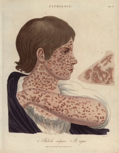 Measles and Rubeole - Litografía de John Pass, publicada en "Encyclopedia Londinensis" por John Wilkes, edición J.Adlard, Londres de Unbekannter Künstler