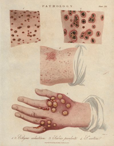 Úlcera cutánea, sarna purulenta y sarna causada por un ácaro sarcóptico scabiei - Litografía de John Pass, publicada en "Encyclopedia Londinensis" por John Wilkes, edición J.Adlard, Londres. de Unbekannter Künstler