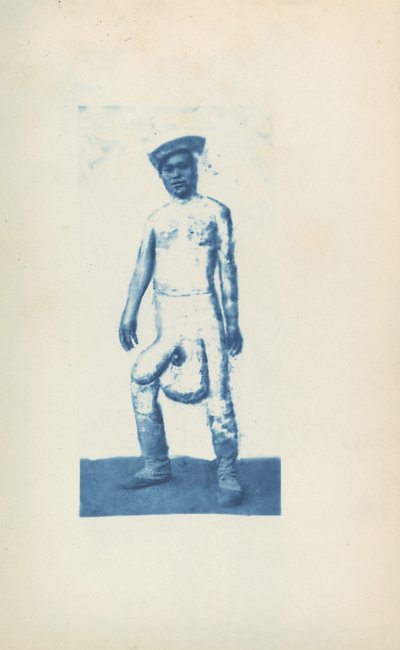 Elefantiasis de Unknown 19th Century