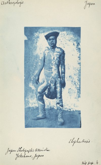 Elefantiasis de Unknown 19th Century
