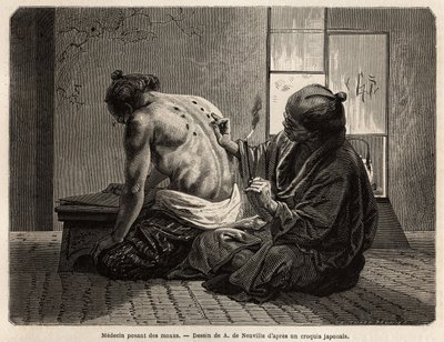 Un médico aplicando moxas (pequeños conos de artemisa quemados en partes específicas del cuerpo), un tratamiento preventivo contra varios síntomas desde la indigestión hasta la falta de apetito, el llanto y el dolor de muelas, empleado dos veces al año y c de Unknown artist