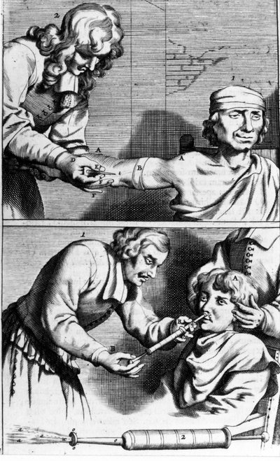 Sangrado y ducha nasal por Johannes Sculpteti “Armamentarium Surgery” Ámsterdam 1672 de Unknown artist