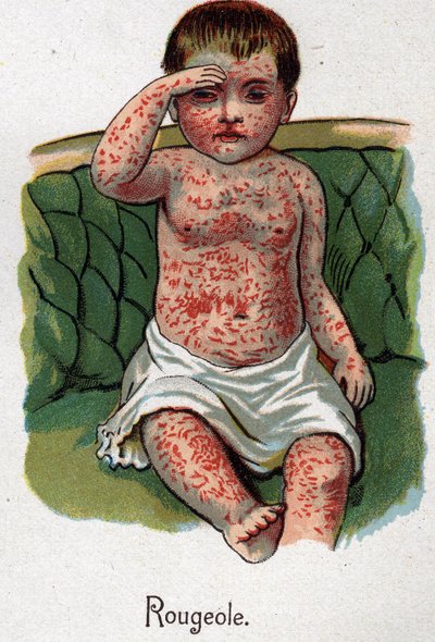 Enfermedades infantiles: Sarampión. En "La nueva medicina natural" de F.E. Bilz. de Unknown artist