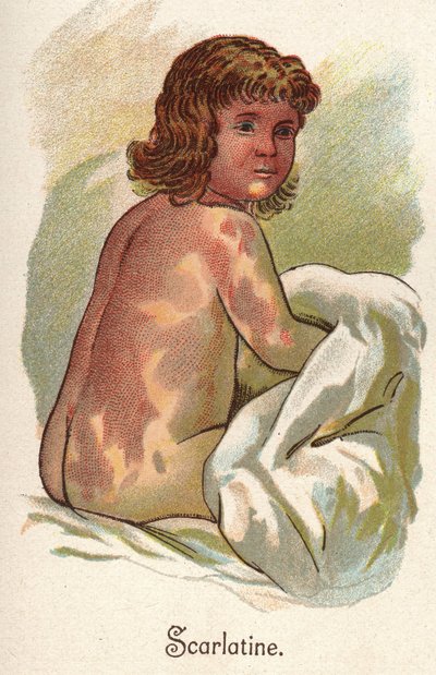 Enfermedades infantiles: Escarlatina. En “La nueva medicación natural” por F.E. Bilz de Unknown artist