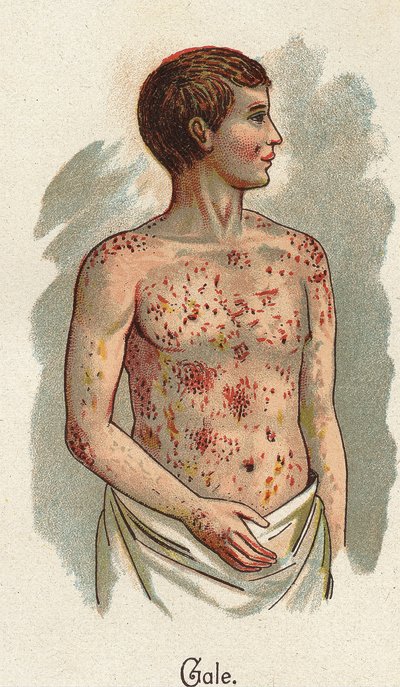 Enfermedades infantiles: La sarna. En “La nueva medicación natural” por F.E. Bilz. de Unknown artist