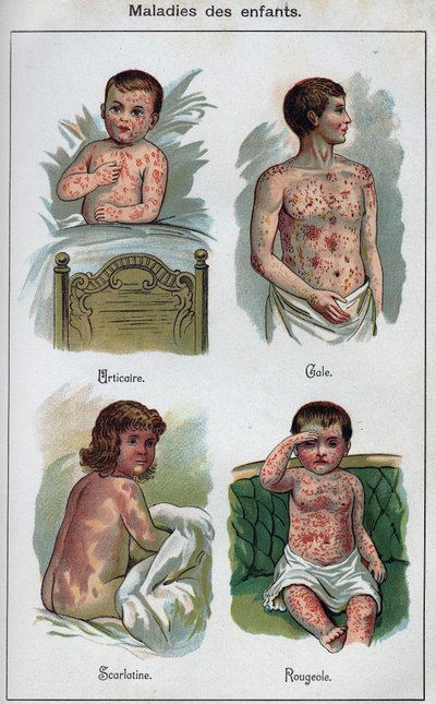 Enfermedades de los niños: Urticaria, sarampión, sarna, escarlatina. En “La nueva medicación natural” por F.E. Bilz de Unknown artist