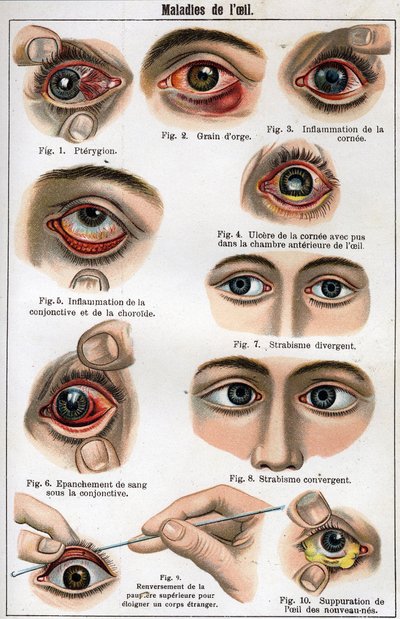 Enfermedades del ojo. “La nueva medicina natural” por F.E. Bilz. de Unknown artist