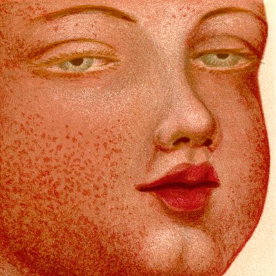 Fiebres eruptivas: Escarlatina o Fiebre Escarlata de Unknown artist