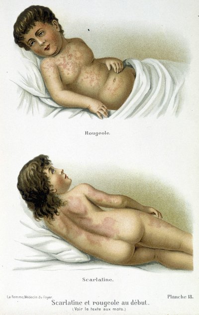 Escarlatina y sarampión - siglo XIX de Unknown artist