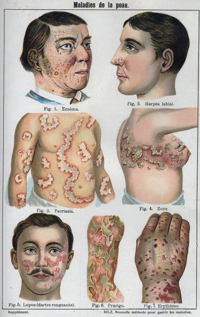 Enfermedades de la piel: Eczema, herpes labial, psoriasis, herpes zóster, lupus, prurigo, eritema. En “La nueva medicación natural” por F.E. Bilz de Unknown artist