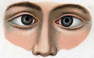 Estrabismo convergente. “La nueva medicación natural” por F.E. Bilz de Unknown artist