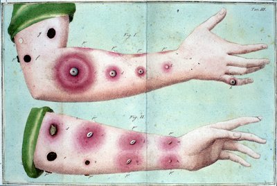 Síntomas de la viruela que causan una erupción de pústulas en la piel. Lámina médica del 