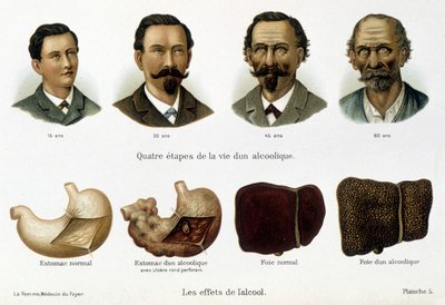 Los efectos del alcohol: las cuatro etapas de la vida de un alcohólico representadas por su rostro y su hígado - en "La mujer, médico del hogar" de Unknown artist