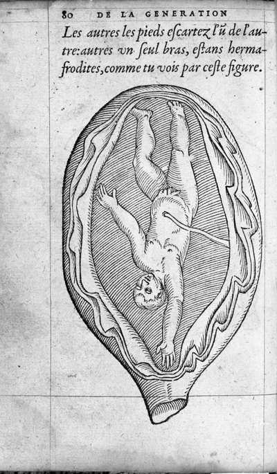 La posición del feto en el útero durante el embarazo. Grabado de “De la generación de los niños” del médico y cirujano francés Ambroise Paré (1509-1590) Siglo XVI de Unknown artist