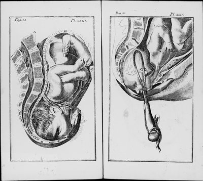 Nacimiento de un bebé con uso de fórceps. Lámina de “Un resumen de la práctica de la obstetricia” de William Smellie (1697-1763) de Unknown artist