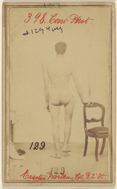 Fractura del tercio superior del fémur. Erastus Worthen, Cuerpo Co. B. 2nd Vermont Vols. 25 años - Residencia Stockbridge VT. de Unknown artist