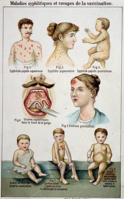 Placa que ilustra las diferentes formas de enfermedades sifilíticas y los peligros de la vacunación - en la medicina natural de Bilz, finales del siglo XIX de Unknown artist