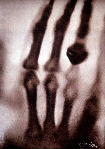 Rayos Roentgen (Röntgen) o rayos X. Primera fotografía: la mano de la esposa de Roentgen. 22/12/1895. de Unknown artist