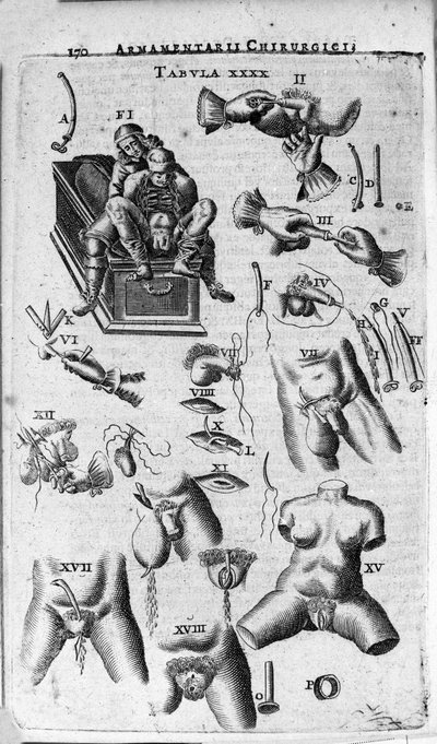 Intervenciones quirúrgicas en los sexos femenino y masculino. Grabado en “Armamentarium Chirurgicum” por J. Scultetus, Venecia de Unknown artist