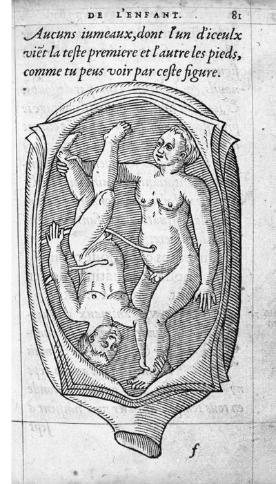 La posición del feto en el útero durante el embarazo. Grabado de “De la generación de los niños” del médico y cirujano francés Ambroise Paré (1509-1590) siglo XVI de Unknown artist