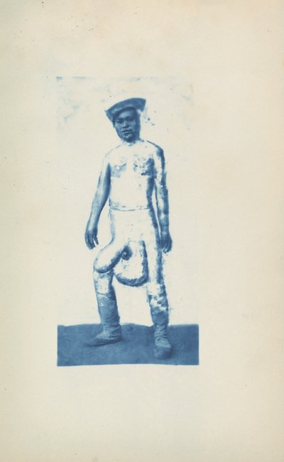 Elefantiasis,c. Década de 1870 (foto) de Unknown photographer
