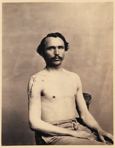 Soldado Adolph Zirsse, escisión intermedia exitosa de la cabeza y dos pulgadas y media del eje del húmero derecho, del catálogo fotográfico de la sección quirúrgica. de William Bell