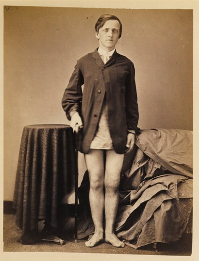 Soldado G. W. Warrington, Recuperación, sin Amputación, tras Fractura por Disparo de Pistola de la Rótula Derecha, del Catálogo Fotográfico de la Sección Quirúrgica. de William Bell