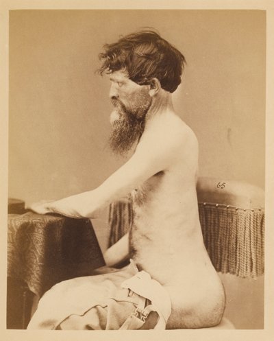 Soldado John Bar, Recuperación tras una herida penetrante en el abdomen con fractura del os innominatum izquierdo, del Catálogo Fotográfico de la Sección Quirúrgica. de William Bell