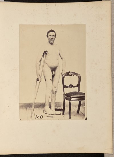 Fractura consolidada por disparo del tercio medio del fémur derecho de William H. Bell