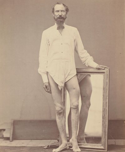 Herida de bala en el tercio medio del fémur izquierdo, 1865-67 de William H. Bell
