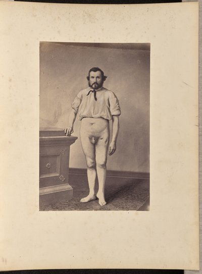 Extirpación con éxito de la cabeza del fémur izquierdo por fractura de bala de William H. Bell