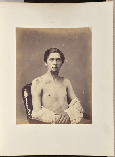 Escisión exitosa de la cabeza del húmero derecho de William H. Bell