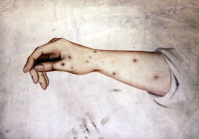 Estudio de un antebrazo con condición de la piel, c.1850 de William Lover