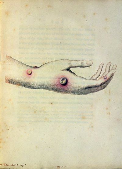 Pústula de viruela vacuna en el brazo de Sarah Nelmes, de 