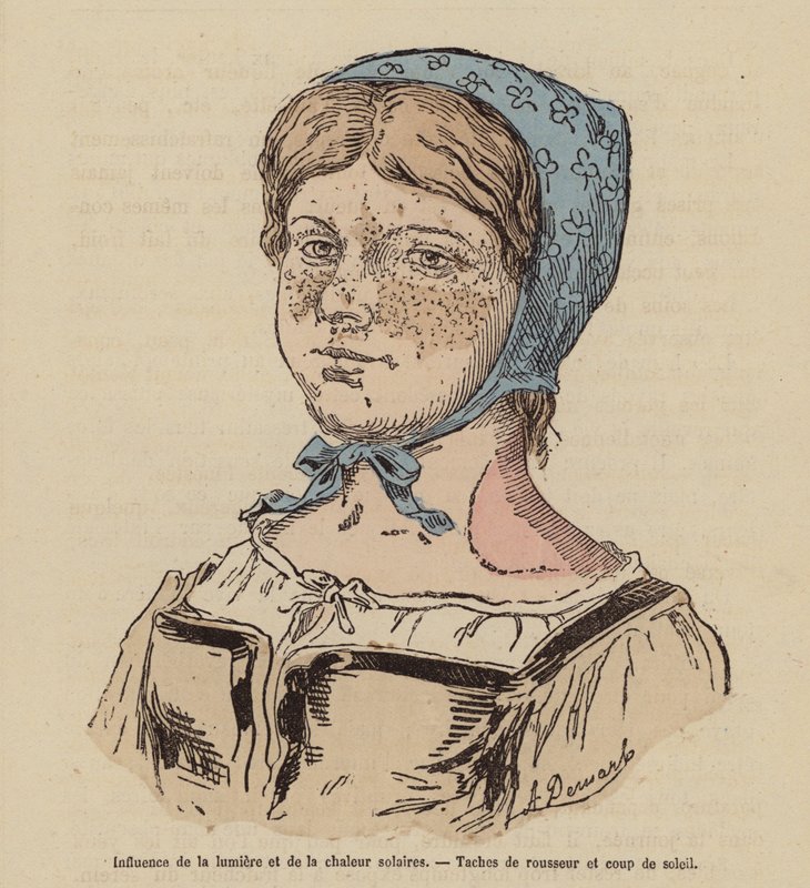 Mujer con pecas y quemaduras solares causadas por una exposición excesiva al Sol (grabado coloreado) de (after) French School