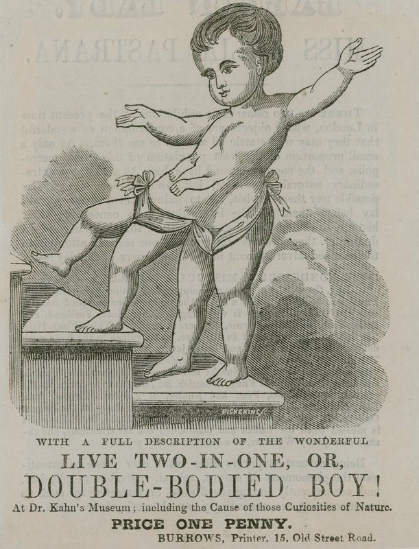 Vivo dos en uno, o niño de doble cuerpo de English School