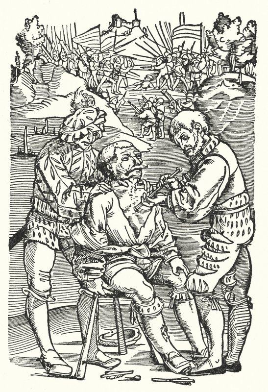 Cirujano barbero extrayendo una flecha (grabado) de European School