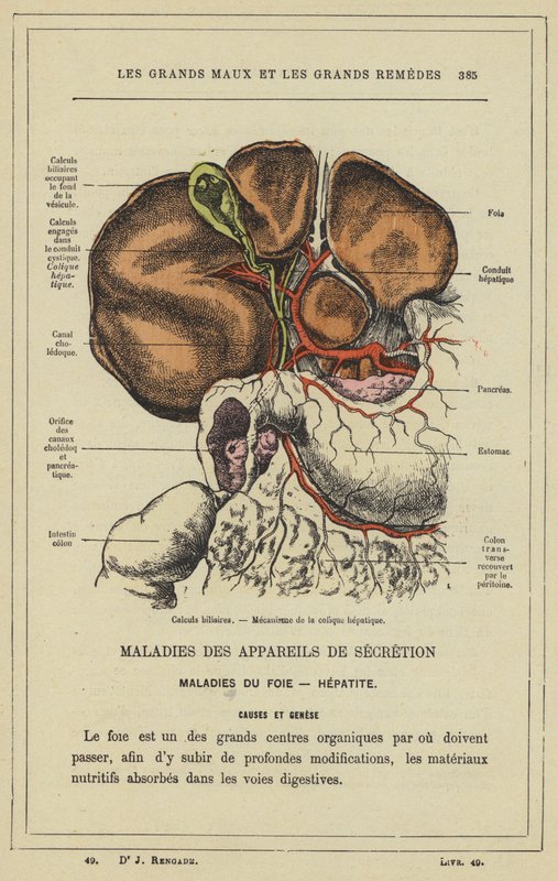 Cálculos biliares, Mecanismo del cólico hepático de French School