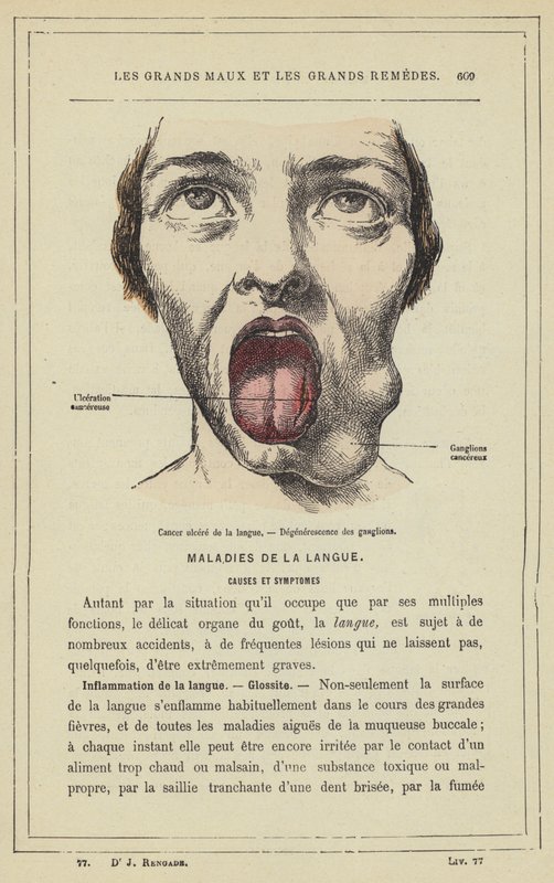 Cáncer ulcerado de la lengua, Degeneración de los ganglios de French School