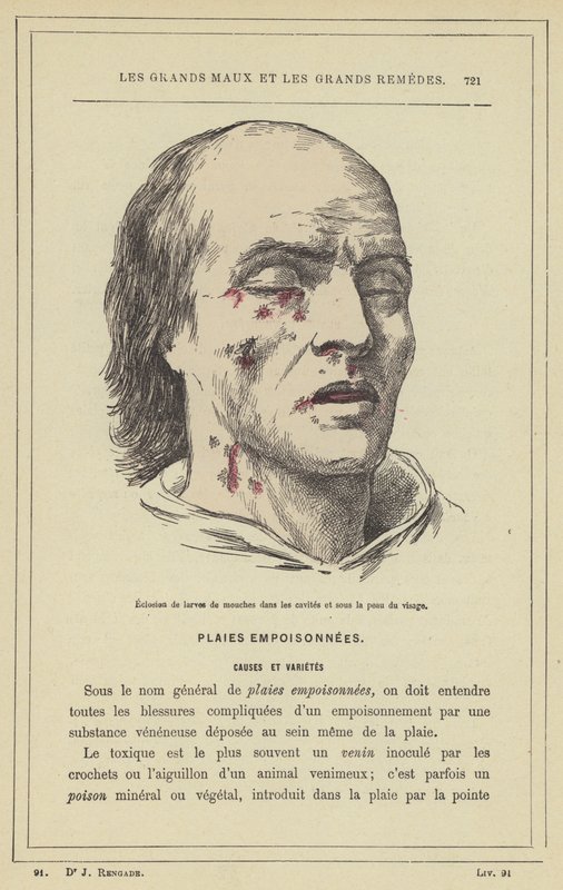 Eclosión de larvas de moscas en las cavidades y bajo la piel del rostro de French School
